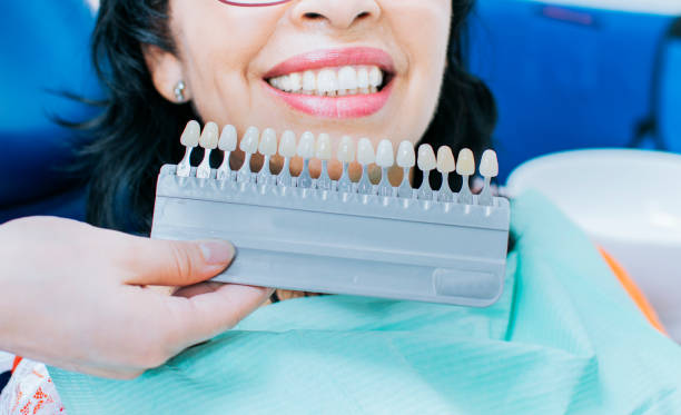 how fast can you see results from teeth whitening