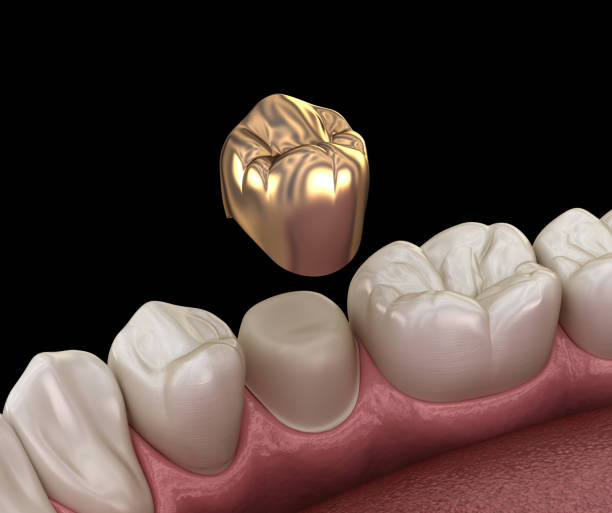 what is a dental crown and when do you need one