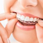 how do mouthguards protect your teeth