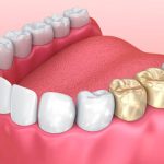 how a crown changes your bite and comfort